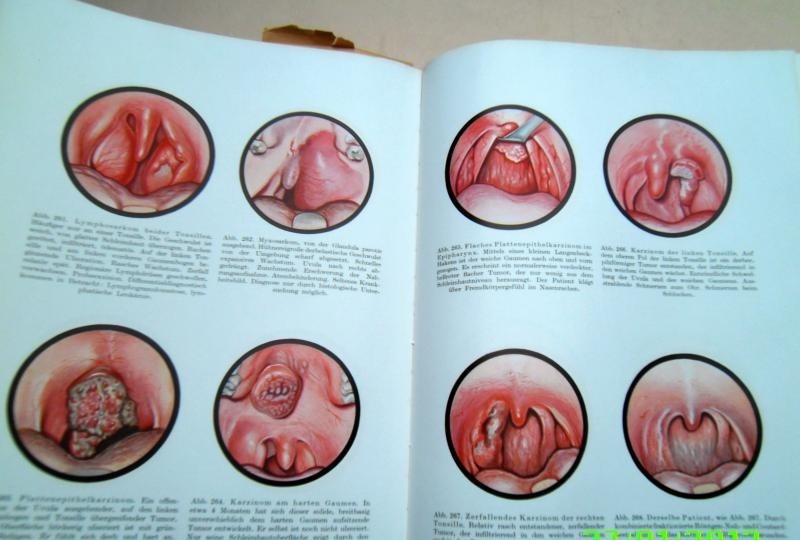 MEDIZIN Atlas HNO 1940 Hals  Nasen  Ohren  Krankheiten Kehlkopf Gehör 